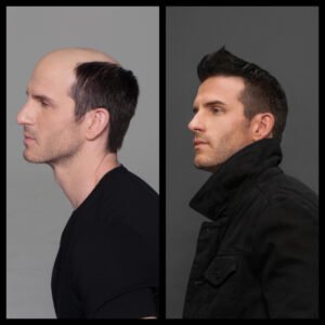 Before And After Photos Of Hair Restoration Customer