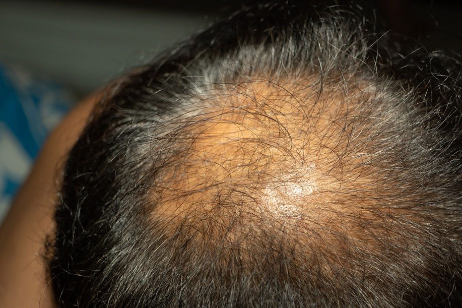 Thinned hair following cancer recovery